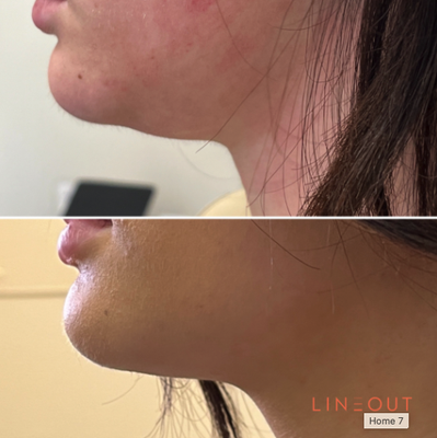 Before & Afters - AN AESTHETIC BOUTIQUE, ENHANCING YOUR NATURAL BEAUTY
