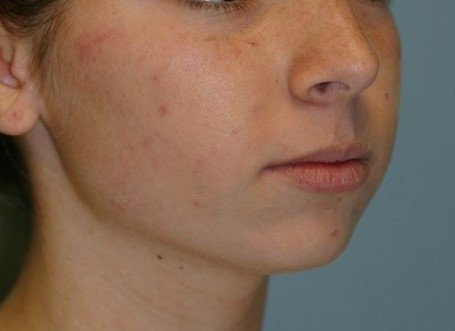 Chin Augmentation - This 18 year old female patient was very self-conscious of her recessive chin. She desired a more defined jaw line and improvement in her profile. Treatment was performed using a chin implant in a 30 minute out-patient procedure under sedation to ensure a totally painless and relaxing experience. The procedure was performed via a small incision in the mouth to produce a scar-less appearance. She was extremely happy with her experience and results.