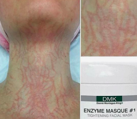 DMK Enzyme Plasmatic Effect Mask - Can be a separate treatment or can be combined with a custom facial for the full effect. DMK is the only company in the world to utilize the beneficial effects of transfer-messenger enzymes. This Enzyme mask uses living enzymes combined with a tightening effect to increase cellular turnover as well as stimulate circulation creating a plasmatic affect. Reducing pigmentation error, effects of aging, and detoxifying skin through lymphatic drainage. This treatment takes about one full hour on its own, and will be combined with a stimulating neck, hand and arm treatment. DMK Enzyme Plasmatic Effect Mask - Can be a separate treatment or can be combined with a custom facial for the full effect. DMK is the only company in the world to utilize the beneficial effects of transfer-messenger enzymes. This Enzyme mask uses living enzymes combined with a tightening effect to increase cellular turnover as well as stimulate circulation creating a plasmatic affect. Reducing pigmentation error, effects of aging, and detoxifying skin through lymphatic drainage. This treatment takes about one full hour on its own, and will be combined with a stimulating neck, hand and arm treatment.