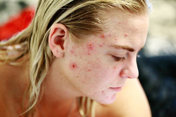 Clear Trouble Treatment - Fight acne, dark spots and blemishes with an anti-acne hydrafacial, DPL laser, and microneedling, leaving your skin flawless and balanced.