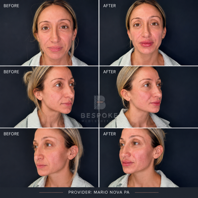 Full facial balancing - Full-face balancing with dermal filler to restore subtle volume, improve facial harmony, and enhance the patient’s natural features from every angle. Treatment was customized for a refreshed, balanced result while maintaining a natural appearance.
Provider: Mario Nova, PA-C | Bespoke Medesthetics • Jericho, NY Full facial balancing - Full-face balancing with dermal filler to restore subtle volume, improve facial harmony, and enhance the patient’s natural features from every angle. Treatment was customized for a refreshed, balanced result while maintaining a natural appearance.
Provider: Mario Nova, PA-C | Bespoke Medesthetics • Jericho, NY