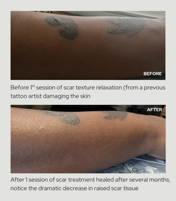 Earth Altar Medical Tattoo - We specialize in:
Areola and nipple restoration after mastectomy or breast reconstruction
3D areola tattooing for breast cancer survivors
Scar camouflage and scar revision tattooing
Navel restoration after tummy tuck (abdominoplasty)
Paramedical tattooing for hyperpigmented and dark skin tones
Artistic solutions for complex scarring where standard approaches fall short
Post-surgical tattoo consultations, including virtual
https://medicaltattoooc.com/services
Many of our clients come to us after being told their skin is too dark, their scars too complex, or their case too difficult. We specialize in exactly those situations. Earth Altar Medical Tattoo - We specialize in:
Areola and nipple restoration after mastectomy or breast reconstruction
3D areola tattooing for breast cancer survivors
Scar camouflage and scar revision tattooing
Navel restoration after tummy tuck (abdominoplasty)
Paramedical tattooing for hyperpigmented and dark skin tones
Artistic solutions for complex scarring where standard approaches fall short
Post-surgical tattoo consultations, including virtual
https://medicaltattoooc.com/services
Many of our clients come to us after being told their skin is too dark, their scars too complex, or their case too difficult. We specialize in exactly those situations.
