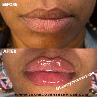 Lip filler - Lip filler can I ban e the natural shape of your lips or fix asymmetrical lip shapes.
