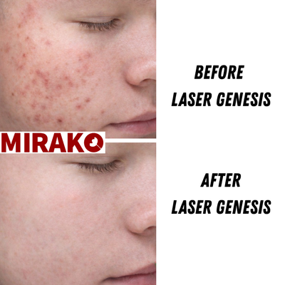 Laser Genesis - Laser Genesis is a non-invasive treatment that helps reduce redness and acne-related inflammation while minimizing the appearance of pores. It also promotes collagen production to improve overall skin tone and texture, with no downtime. Laser Genesis - Laser Genesis is a non-invasive treatment that helps reduce redness and acne-related inflammation while minimizing the appearance of pores. It also promotes collagen production to improve overall skin tone and texture, with no downtime.