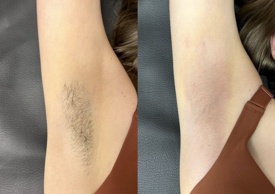 Underarm Sugaring - Get smooth, hair free underarms in less than 15 minutes with results that last 4-6 weeks!! Underarm Sugaring - Get smooth, hair free underarms in less than 15 minutes with results that last 4-6 weeks!!