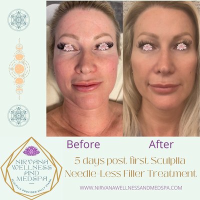 Sculplla Needle Free Filler Treatment - I will say that TMP Ultrasound packs a punch, you will feel muscles twitching and skin tightening, and it is totally painless and can actually be make you feel almost ticklish. You don’t risk getting burns either! 

TMP Ultrasound uses LOW FREQUENCY Ultrasound waves at 90 KHz (90,000 sound waves per second). Ultrasound uses sound waves, not heat. Ultrasound creates cellular disturbance to boost collagen production and results in no outward injury to the skin and no downtime. This level of frequency is therapeutic for wound healing, improved blood oxygenation, increased collagen, mesoporation (product absorbtion), and I’m seeing a fast and lasting plumping of the skin for wrinkle reduction!

Sculplla is an amazing needle-free, painless, non-invasive filler treatment that has no down time. This treatment utilizes Poly L Lactic Acid [PLLA], and has peptides like EGF which helps collagen production. Skin gets brighter with use, pores tighten, blackheads are reduced, and of course it has the youthful plumping effect. 

PLLA is the same ingredient found in SCULPTRA™,  an injectable dermal filler that contains micro-particles of PLLA. 

Sculplla’s PLLA enables the penetration via hair follicles, of the anti-aging ingredients such as caffeine, oxygen, and niacinmide into the dermis which creates a plumping effect that smooths out fine lines and wrinkles. PLLA supercharges the body’s ability to rebuild collagen, which is lost with aging, sun damage, and poor skin care. PLLA is also found in dissolvable sutures. It’s the ingredient that triggers wound healing and new collagen growth. 

As many serious skincare enthusiasts know, K-Beauty, or Korean skincare is light years ahead of most countries! Sculplla was created by Korean physicians and scientists. The focus was on natural, beneficial ingredients, like oxygen, snail mucin, EGF, and PLLA. These ingredients produce medical grade results because the skin starts producing more Collagen, hydration levels and cellular metabolism are increased. In turn making the skin appear younger! Sculplla took over 10 years of research, and clinical trials to create! Not only is the Sculplla treatment incredible, but the products are amazing too! 

I am one of only a handful of providers that offer Sculplla in the central Texas area. My clients are absolutely freaking out for this treatment, as am I!
I’m truly blown away with the results I am seeing, and that’s why I’ve opted to pair these two treatments together!