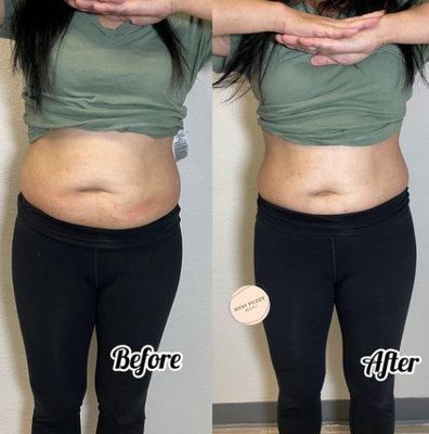 Body Sculpting - We use a combination of cavitation, radio frequency, wood therapy, vacuum therapy and lipo laser. We customize services based on customer needs. Body Sculpting - We use a combination of cavitation, radio frequency, wood therapy, vacuum therapy and lipo laser. We customize services based on customer needs.