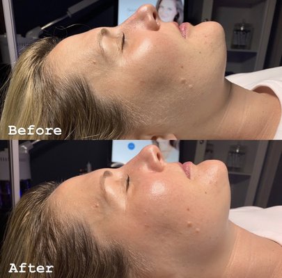 Dermaplaning and Hydrafacial - Dermaplaning is a powerful physical exfoliation that stimulates the production of new skin cells, thus smoothing away rough texture issues and restoring a vibrant complexion. We finish with HydraFacial to cleanse, extract, hydrate and protect your skin in a custom way that’s entirely designed for your unique needs. Dermaplaning and Hydrafacial - Dermaplaning is a powerful physical exfoliation that stimulates the production of new skin cells, thus smoothing away rough texture issues and restoring a vibrant complexion. We finish with HydraFacial to cleanse, extract, hydrate and protect your skin in a custom way that’s entirely designed for your unique needs.