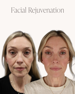Facial Balancing - Beautiful results begin with treating the face as a whole—not focusing on a single feature. Facial balancing is a comprehensive approach that evaluates facial proportions, structure, volume loss, and natural anatomy to create a personalized treatment plan.
Depending on your goals, treatment may include dermal fillers, neurotoxins, Sculptra, regenerative therapies, laser treatments, or medical-grade skincare. Rather than chasing individual lines or wrinkles, we focus on restoring balance, enhancing your natural beauty, and creating results that look refreshed—not overdone. Facial Balancing - Beautiful results begin with treating the face as a whole—not focusing on a single feature. Facial balancing is a comprehensive approach that evaluates facial proportions, structure, volume loss, and natural anatomy to create a personalized treatment plan.
Depending on your goals, treatment may include dermal fillers, neurotoxins, Sculptra, regenerative therapies, laser treatments, or medical-grade skincare. Rather than chasing individual lines or wrinkles, we focus on restoring balance, enhancing your natural beauty, and creating results that look refreshed—not overdone.