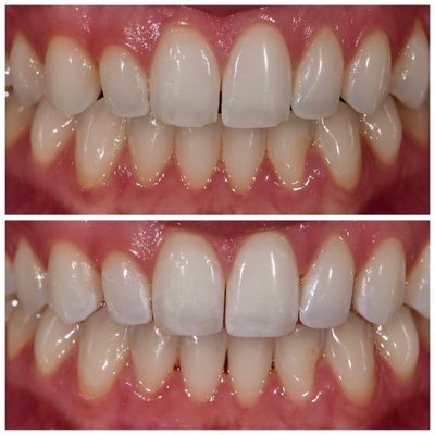 Composite Bondings - Composite Bonding Cases