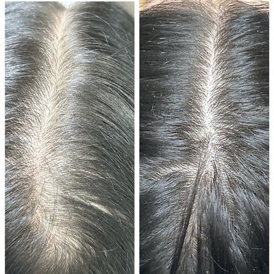 Hair Restoration Before and After 4 Months Ultrasound with DeRive Serum. - Ultrasound once per month with no pain and DeRive Hair Serum drives results in hair growth, thickness and strength. Photos of before and after are results from 4 months of use. Call 405-888-5614 for a free consultation. Hair Restoration Before and After 4 Months Ultrasound with DeRive Serum. - Ultrasound once per month with no pain and DeRive Hair Serum drives results in hair growth, thickness and strength. Photos of before and after are results from 4 months of use. Call 405-888-5614 for a free consultation.