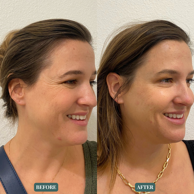 Results | Wrinkle Relaxers - Botox®, Dysport® and Jeuveau are Wrinkle Relaxers that we offer, medically known as Neurotoxins. This non-invasive treatment addresses dynamic wrinkles that are accentuated during facial expression. Over time the repetitive muscle contractions such as smiling or frowning form fine lines and deeper wrinkles that become etched into our skin. These injectable solutions can be specifically tailored to help soften or decrease the movement that creates the wrinkles. The paralyzing of the muscle often leads to a smoother complexion with a more youthful appearance.