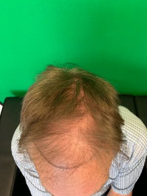 Before & After Artas iXi Operation - This operation was completed in 2024, the photos displayed show pictures of the client pre operation and post operation, with a much fuller and defined hairline. Before & After Artas iXi Operation - This operation was completed in 2024, the photos displayed show pictures of the client pre operation and post operation, with a much fuller and defined hairline.