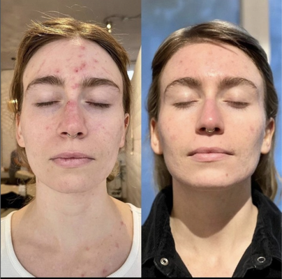 VI Peel Treatments - This patient had a mild case of acne, which was treated with a VI Peel Precision Plus treatment. VI Peel Treatments - This patient had a mild case of acne, which was treated with a VI Peel Precision Plus treatment.
