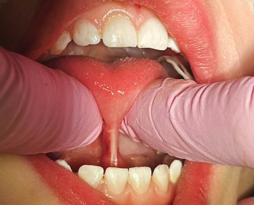 Tongue Tie and Lip Flange Experts - Whether it's a tongue tie causing speech delays or feeding issues, or a lip flange causing malformation of the skeleton, Dr. Benitez can take care of your child with ease. See more here at https://www.instagram.com/ccpdtonguetie/