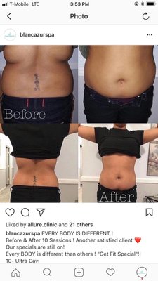 Ultra Cavitation Transformations - This portfolio shows the results of our clients who undergo Ultra Cavitation
