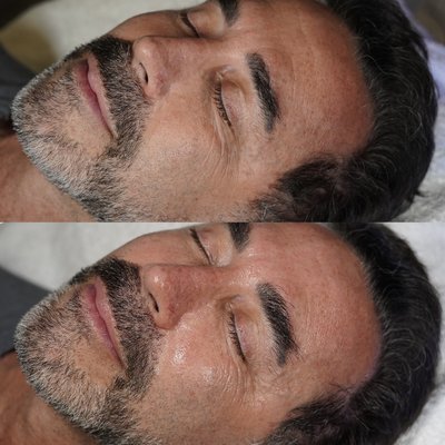 Glowing Skin - Before and After Photos for Hydrafacial, Acne Treatments, LED Therapy & More Glowing Skin - Before and After Photos for Hydrafacial, Acne Treatments, LED Therapy & More