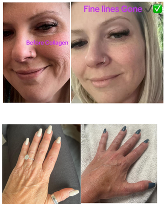 Sculptra Treatment - ✨ Restore. Rebuild. Rejuvenate. ✨
Experience the power of collagen stimulation with Sculptra at Ageless by Isabelle Wilcox in Ontario, CA. Unlike traditional fillers, Sculptra works gradually to restore facial volume and improve skin texture by boosting your body’s natural collagen production. Perfect for treating hollow cheeks, temples, and overall facial volume loss—giving you a refreshed, lifted, and youthful appearance that lasts up to 2 years. Sculptra Treatment - ✨ Restore. Rebuild. Rejuvenate. ✨
Experience the power of collagen stimulation with Sculptra at Ageless by Isabelle Wilcox in Ontario, CA. Unlike traditional fillers, Sculptra works gradually to restore facial volume and improve skin texture by boosting your body’s natural collagen production. Perfect for treating hollow cheeks, temples, and overall facial volume loss—giving you a refreshed, lifted, and youthful appearance that lasts up to 2 years.