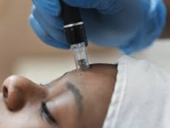 Microneedling - Improve the texture and the appearance of your skin. Book your appointment now! Microneedling - Improve the texture and the appearance of your skin. Book your appointment now!