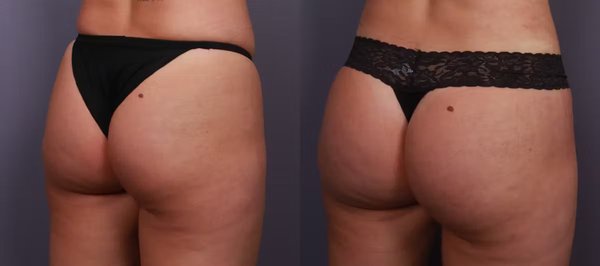 Brazilian Butt Lift - Brazilian Butt Lift, Liposuction, and BodyTite performed by Dr. Justin Perez. Patient was 31, female, and final images were captured at 6 months post-op. Brazilian Butt Lift - Brazilian Butt Lift, Liposuction, and BodyTite performed by Dr. Justin Perez. Patient was 31, female, and final images were captured at 6 months post-op.