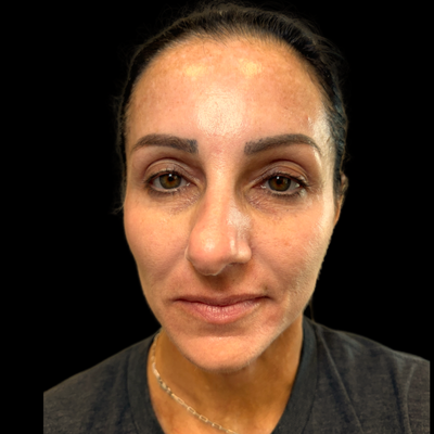 Rhinoplasty & Blepharoplasty - The patient really desired a smaller and more balanced nose and improve her tired eyes. She has been thinking about surgery for a long time but was afraid to get started. Now, she is in love with her face and so happy she went through with this life changing journey. Rhinoplasty & Blepharoplasty - The patient really desired a smaller and more balanced nose and improve her tired eyes. She has been thinking about surgery for a long time but was afraid to get started. Now, she is in love with her face and so happy she went through with this life changing journey.