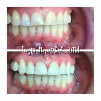 Gum Surgery - A collection of periodontal gum surgery performed by Dr. Rozita Nosratabadi Gum Surgery - A collection of periodontal gum surgery performed by Dr. Rozita Nosratabadi