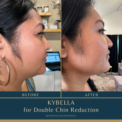 Kybella for Double Chin - Permanently dissolve fat cells under the chin and sharpen the jawline with Kybella.