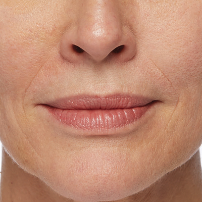 Restylane Silk - Before and after 3mL Restylane Silk in lips and smile lines Restylane Silk - Before and after 3mL Restylane Silk in lips and smile lines