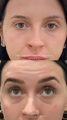 PRF Undereye Injection - PRF Undereye PRF Undereye Injection - PRF Undereye