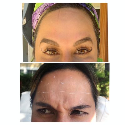 Before / After Botox - Real before and after treatment photos of our clients and receiving Botox or similar neurotoxins. Botox relaxes muscle tone resulting in wrinkles reduction/ prevention and even facial shaping. We specialize in Baby Botox and Mircotox in addition to traditional techniques.