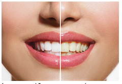 Cosmetic Dental Services - Teeth Whitening
Porcelain Veneers
Smile Makeover
Cosmetic Dental Bonding