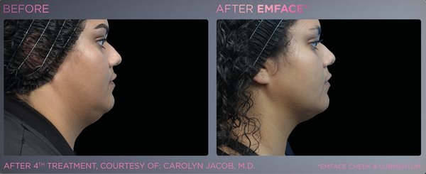 Emface - At Comfy Dental Studios in Beverly Hills, facial care is approached through the lens of balance, function, and long-term harmony rather than traditional aesthetic injections. Our practice offers EMFACE as part of a comprehensive facial balancing approach that complements cosmetic dentistry and supports both appearance and muscle health without needles or surgery.

EMFACE is a non-invasive treatment that uses a combination of HIFES (High-Intensity Focused Electromagnetic Stimulation) and radiofrequency (RF) technology to strengthen facial muscles while improving skin quality. This dual-energy approach supports natural facial structure, improves tone, and enhances overall facial balance in a way that aligns with dental and functional facial care.

Rather than altering facial volume, EMFACE works by improving the foundation of the face. Stronger, better-coordinated facial muscles and healthier skin contribute to a refreshed, well-supported appearance that looks natural and proportional.

Facial Balancing as an Extension of Cosmetic Dentistry
Facial balance plays a critical role in how a smile is perceived. The position of the cheeks, lips, jawline, and surrounding musculature directly affects facial symmetry and expression. At Comfy Dental Studios, EMFACE is used to support facial harmony alongside cosmetic dental treatments such as smile design, veneers, and bite optimization.

By strengthening key facial muscles and stimulating collagen production, EMFACE helps create a more stable and balanced facial framework. This can enhance the overall outcome of cosmetic dentistry by improving how the face supports the smile, rather than focusing on isolated cosmetic changes.

For patients seeking a needle-free option to improve facial tone and balance, EMFACE offers a clinically appropriate solution that aligns with modern dental care.

EMFACE for TMJ and Jaw Muscle Support
In addition to facial balancing, EMFACE offers meaningful benefits for patients experiencing TMJ-related discomfort. Jaw tension, clenching, and muscle overactivity are common contributors to headaches, facial soreness, and neck strain. EMFACE includes a TMJ-focused protocol designed to address these concerns without medication or injections.

This approach uses controlled electromagnetic stimulation to target overactive jaw and facial muscles. By encouraging muscle relaxation and improved coordination, EMFACE can help reduce tension associated with clenching and bruxism. Many patients report noticeable relief in jaw tightness and facial fatigue as treatment progresses.

When used alongside dental solutions such as nightguards or bite evaluations, EMFACE supports both functional comfort and facial muscle health.

How EMFACE Works
EMFACE delivers its effects through two complementary technologies:

HIFES technology stimulates targeted facial muscles, encouraging strengthening and improved muscle tone. This supports facial posture and balance by enhancing the muscles responsible for lift and stability.

Radiofrequency energy gently heats the deeper layers of the skin, stimulating collagen and elastin production. Over time, this leads to firmer, smoother, and more resilient skin.

Together, these technologies address both muscle function and skin quality in a single treatment. Sessions are comfortable, efficient, and require no preparation or downtime.

Benefits of EMFACE Facial Balancing
EMFACE offers a range of benefits that support both appearance and function:

Improved facial muscle tone without injections
Enhanced facial balance and symmetry
Firmer, healthier skin through collagen stimulation
Support for cosmetic dental outcomes
Reduction in jaw tension and facial muscle fatigue
Non-invasive and needle-free treatment
No downtime or recovery period
Suitable for a wide range of patients
Because EMFACE focuses on strengthening and supporting natural facial structures, results develop gradually and look authentic rather than exaggerated.

EMFACE Treatment Protocol
Most patients complete a series of four EMFACE sessions, typically spaced one week apart. This allows facial muscles to strengthen progressively while collagen production builds over time.

Some individuals notice changes after the first session, such as improved muscle engagement or reduced jaw tightness. Final results continue to develop over several weeks following the treatment series.

EMFACE can be used as a standalone facial balancing treatment or integrated into a broader cosmetic dentistry plan. Its flexibility and lack of downtime make it easy to schedule around work, family, and social commitments.

EMFACE and Long-Term Facial Health
Facial muscles play a role in expression, chewing, speech, and overall facial support. Maintaining their strength and coordination contributes not only to appearance but also to comfort and function. EMFACE supports this goal by addressing facial health at a foundational level.