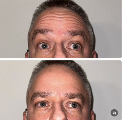 Botox and Dysport Injections - Both clients had a procedure (male) of brotox injections and our females client had a Dysport procedure. 
Both clients aim to target frown lines, glabella lines, and crows feet. 
Both patients left satisfied with their results!