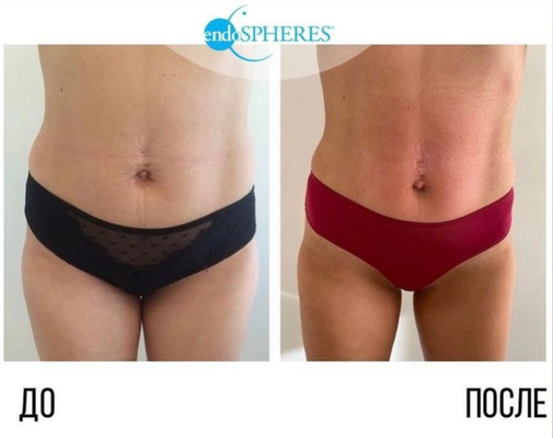 Get 20% Off Your First Appointment! Non Invasive Non Surgical - Body Contouring First visit 150$ Non Surgical Body Shaping Reduce Fat & Cellulite Lymphatic Drainage Skin Tightening Cellulite Removal