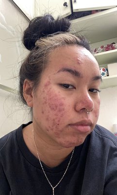 Acne Client - This Acne Bootcamp client came to me as a last resort for her acne struggles. She had suffered from deep, cystic, painful, and inflamed acne. With her commitment to consistency in 2x/monthly treatments as well as a fully customized home care regimen, we have been able to clear her, and keep her clear! Acne Client - This Acne Bootcamp client came to me as a last resort for her acne struggles. She had suffered from deep, cystic, painful, and inflamed acne. With her commitment to consistency in 2x/monthly treatments as well as a fully customized home care regimen, we have been able to clear her, and keep her clear!