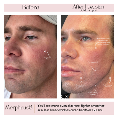 Morpheus8 Before and Afters by Dr. Murgasen - Dr. Murgasen's favorite treatment for his clients is Morpheus8. Here's Why:
1. Tightens Skin
2. Erases Acne Scarring
3. Helps remove stretch marks
4. Treats excessive sweating
5. Provides a subtle facial lifting
6. Boosts collagen for results that last for years. Morpheus8 Before and Afters by Dr. Murgasen - Dr. Murgasen's favorite treatment for his clients is Morpheus8. Here's Why:
1. Tightens Skin
2. Erases Acne Scarring
3. Helps remove stretch marks
4. Treats excessive sweating
5. Provides a subtle facial lifting
6. Boosts collagen for results that last for years.