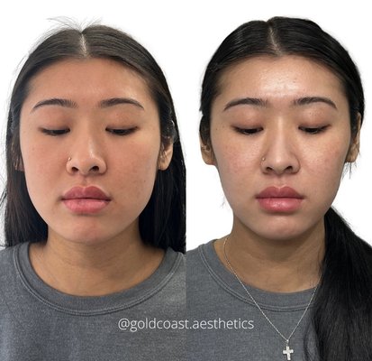 Lower Face Balancing - Lower Face Balancing Using Combination Treatments Lower Face Balancing - Lower Face Balancing Using Combination Treatments