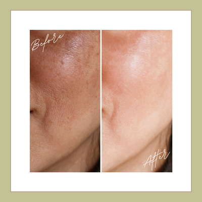 Dermal Filler - xperience Timeless Beauty with Dermal Filler Injections at CKE Rejuvenation
Ready to turn back time with Dermal Fillers for natural-looking, youthful Contours without surgery? Look no further than CKE Rejuvenation, Henrico's premier medical spa specializing in natural-looking dermal filler injections.
We are committed to helping you achieve your desired results while preserving your individuality. Our natural-looking dermal filler injections will leave you looking and feeling rejuvenated, confident, and ready to take on the world. Dermal Filler - xperience Timeless Beauty with Dermal Filler Injections at CKE Rejuvenation
Ready to turn back time with Dermal Fillers for natural-looking, youthful Contours without surgery? Look no further than CKE Rejuvenation, Henrico's premier medical spa specializing in natural-looking dermal filler injections.
We are committed to helping you achieve your desired results while preserving your individuality. Our natural-looking dermal filler injections will leave you looking and feeling rejuvenated, confident, and ready to take on the world.