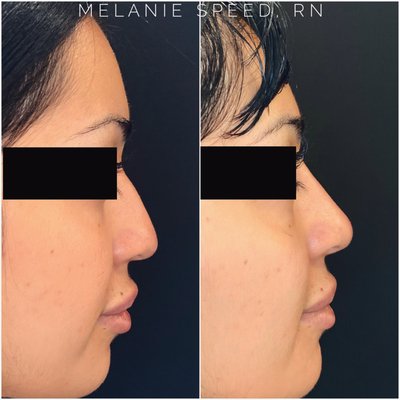 Non Surgical Nose Augmentation - Before and After Non Surgical Nose Augmentation Non Surgical Nose Augmentation - Before and After Non Surgical Nose Augmentation