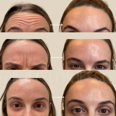 Tox (Dysport/Daxxify/Xeomin) - Neuromodulators are wrinkle-relaxing injections of botulinum toxin – known as Botox Cosmetic, Dysport, Xeomin or Daxxify – that are used to treat wrinkles, frown lines and crow's feet as well as many other areas. Tox (Dysport/Daxxify/Xeomin) - Neuromodulators are wrinkle-relaxing injections of botulinum toxin – known as Botox Cosmetic, Dysport, Xeomin or Daxxify – that are used to treat wrinkles, frown lines and crow's feet as well as many other areas.