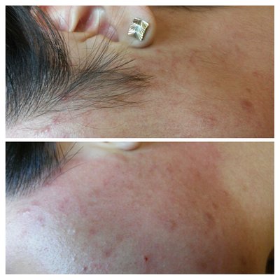 Final effort to get rid of your unwanted hair. - I work on all sorts of hair, fine, coarse, dark, blond and curly. This is the final way of hair removal approved by FDA. Final effort to get rid of your unwanted hair. - I work on all sorts of hair, fine, coarse, dark, blond and curly. This is the final way of hair removal approved by FDA.