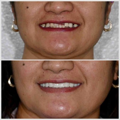 Smile Transformations by Dental Lounge - Transforming Smiles at Dental Lounge – See Our Results!
At Dental Lounge, we specialize in life-changing smile transformations using the latest in dental technology and cosmetic techniques. From Invisalign to dental implants, veneers, and crowns, our personalized care delivers both beauty and function.
Take a look at these real patient results:
• Veneers & Crowns: Our patient came in with worn, discolored, and misaligned teeth with multiple missing teeth. Using custom-designed crowns and porcelain veneers after Invisalign, we restored her smile to a natural, confident, and radiant look.
• Invisalign: This patient had crowding and spacing issues that we corrected using clear aligners. The final result is a straighter, healthier smile without the need for metal brackets and wire braces.
We are proud to provide gentle, high-quality dentistry in a comfortable environment. Whether you’re looking for cosmetic enhancements or full mouth rehab, Dental Lounge is your home for modern, honest dental care.
Contact us today to schedule your consultation and see what’s possible! Smile Transformations by Dental Lounge - Transforming Smiles at Dental Lounge – See Our Results!
At Dental Lounge, we specialize in life-changing smile transformations using the latest in dental technology and cosmetic techniques. From Invisalign to dental implants, veneers, and crowns, our personalized care delivers both beauty and function.
Take a look at these real patient results:
• Veneers & Crowns: Our patient came in with worn, discolored, and misaligned teeth with multiple missing teeth. Using custom-designed crowns and porcelain veneers after Invisalign, we restored her smile to a natural, confident, and radiant look.
• Invisalign: This patient had crowding and spacing issues that we corrected using clear aligners. The final result is a straighter, healthier smile without the need for metal brackets and wire braces.
We are proud to provide gentle, high-quality dentistry in a comfortable environment. Whether you’re looking for cosmetic enhancements or full mouth rehab, Dental Lounge is your home for modern, honest dental care.
Contact us today to schedule your consultation and see what’s possible!