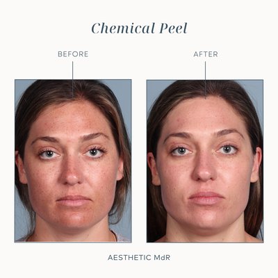 Chemical Peels - Chemical peels are effective and well suited for the face, hands and neck, and may be used to treat several common conditions including uneven skin tone, wrinkles, fine lines under the eyes and mouth and certain types of acne or melasma.