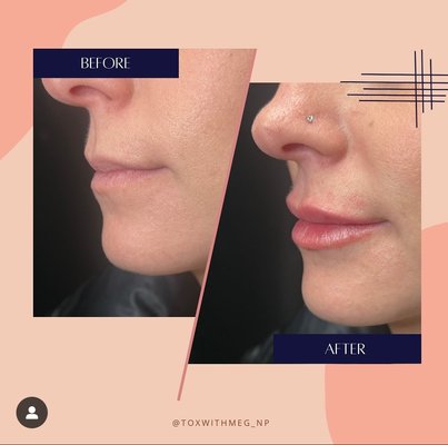 FREE CONSULT with our expert Injectors for lips, chins, everything! - At MediMorph, our expert injectors are skilled in administering some of the most popular dermal fillers in the world. There is a filler that can meet the anti-aging and cosmetic needs of everyone.
These injectables deliver long-lasting, natural, and immediate results. If you're looking for a way to restore youth to your complexion, enhance your features, or achieve a combination of both, we can help. We believe in a synergistic approach to health and wellness and want to work with you to incorporate different aspects of our offered treatments to optimize your health. Dermal fillers can be a key part of this approach. At MediMorph, we choose the highly popular Restylane® and JUVÉDERM dermal fillers to help you reach your aesthetic goals. FREE CONSULT with our expert Injectors for lips, chins, everything! - At MediMorph, our expert injectors are skilled in administering some of the most popular dermal fillers in the world. There is a filler that can meet the anti-aging and cosmetic needs of everyone.
These injectables deliver long-lasting, natural, and immediate results. If you're looking for a way to restore youth to your complexion, enhance your features, or achieve a combination of both, we can help. We believe in a synergistic approach to health and wellness and want to work with you to incorporate different aspects of our offered treatments to optimize your health. Dermal fillers can be a key part of this approach. At MediMorph, we choose the highly popular Restylane® and JUVÉDERM dermal fillers to help you reach your aesthetic goals.