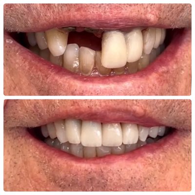 Dental Implants - Dental Implants Dental Implants - Dental Implants