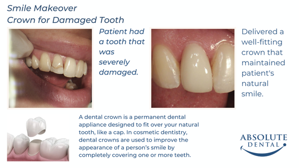 Crown for Damaged Tooth - Patient had a tooth that was severely damaged. Delivered a well-fitting crown that maintained patient's natural smile. Crown for Damaged Tooth - Patient had a tooth that was severely damaged. Delivered a well-fitting crown that maintained patient's natural smile.