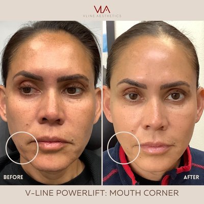 Mouth Corner - Loss of jawline can be due to:
Loose/sagging skin
Downward pulling force by Platysmal muscle
Common complaint:
“My face is getting more droopy and round”
“I look more manly as I age” Mouth Corner - Loss of jawline can be due to:
Loose/sagging skin
Downward pulling force by Platysmal muscle
Common complaint:
“My face is getting more droopy and round”
“I look more manly as I age”
