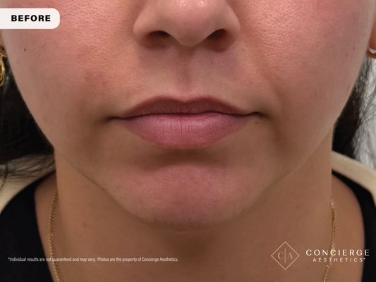 Natural Chin Filler + Lip Balancing in Irvine - Subtle chin and lip filler enhancement designed to improve lower face balance and facial proportions. By adding soft projection to the chin along with natural lip volume, we created a more harmonious, refined result without looking overdone.