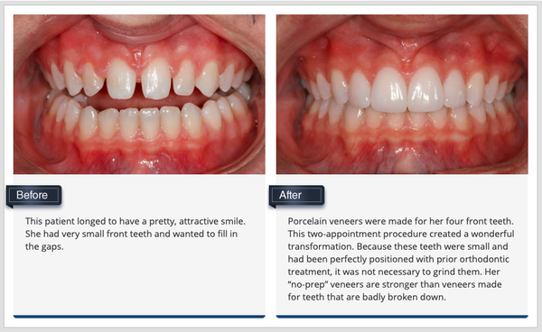 Porcelain Veneers - We consider porcelain veneers to be some of the ultimate tools of cosmetic dentistry. These thin, sculpted layers are applied to the front of the teeth. Porcelain veneers can dramatically improve the position, size, color and shape of your teeth while maintaining a natural sheen and translucency.
Porcelain is also harder than tooth enamel, so it resists wear and staining. In fact, veneers do not discolor with age like natural teeth. All veneers are custom-fabricated and can provide permanent aesthetic results in just two appointments. Drs. Pavinee and Alvarado are experts in the placement, design and coloration of veneers, so they can create results that look just like your natural teeth, only better. Porcelain Veneers - We consider porcelain veneers to be some of the ultimate tools of cosmetic dentistry. These thin, sculpted layers are applied to the front of the teeth. Porcelain veneers can dramatically improve the position, size, color and shape of your teeth while maintaining a natural sheen and translucency.
Porcelain is also harder than tooth enamel, so it resists wear and staining. In fact, veneers do not discolor with age like natural teeth. All veneers are custom-fabricated and can provide permanent aesthetic results in just two appointments. Drs. Pavinee and Alvarado are experts in the placement, design and coloration of veneers, so they can create results that look just like your natural teeth, only better.