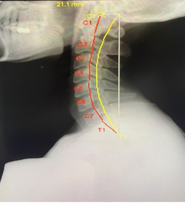 Cervical spinal realignment - The patient had suffered neck pain. Patient pain was diminished as his cervical spine was restored to normal curvature. Cervical spinal realignment - The patient had suffered neck pain. Patient pain was diminished as his cervical spine was restored to normal curvature.
